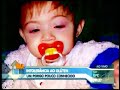 Doen�a Cel�aca no Hoje em Dia 02/03