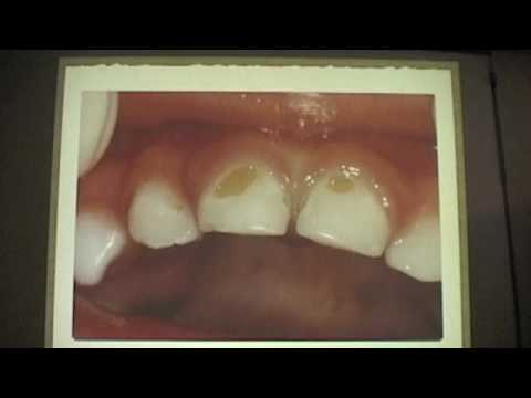 Child dental care - Part 5