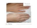 Laser Hair Removal Laser Hair Removal