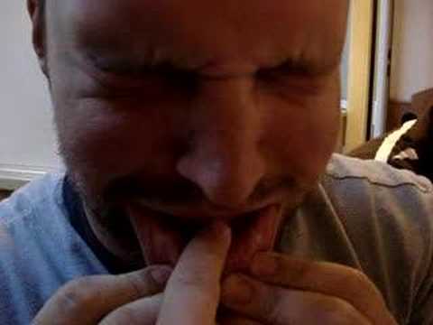 Canker Sore Treatment