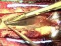 Subdural Hematoma in Lumbar Area from Subarachnoid Hemorrhage Inside the Cranium: Foot Drop on the Both Sides Subdural Hematoma in Lumbar Area from Subarachnoid Hemorrhage Inside the Cranium: Foot Drop on the Both Sides