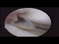 medial meniscus arthroscopy