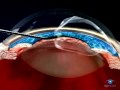General Principles Capsulorhexis Phaco basic techniques General Principles Capsulorhexis Phaco basic techniques