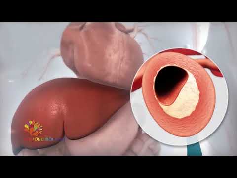 Bệnh xơ vữa động mạch vành - VUI SỐNG MỖI NGÀY - VTV3