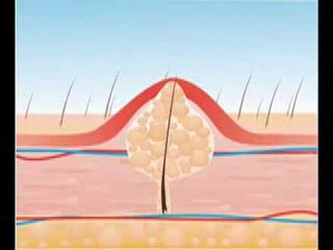 how to apply erytop gel