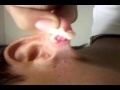 huge zit