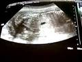 videos de it's a Boy! ( 24weeks scan )