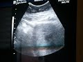 12 week sonogram part 3