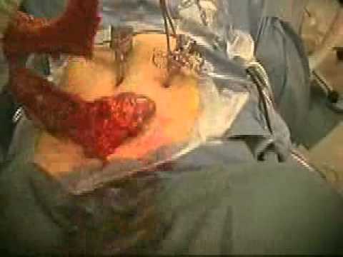 Colon Surgery - Monmouth Medical Center is the region's leader in surgical services, earning a statewide reputation for excellence in the field. Throughout its history, the ...