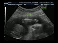 Baby's First DVD sonogram five months....