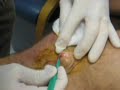 Sebaceous Cyst Removal