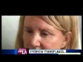 Eyebrow Transplant by Dr. Sean Behnam