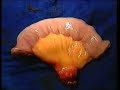 Rekonstruktion Oesophagus