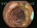 pseudomembranecolitis pseudomembranecolitis