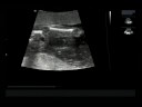 20 Week Sonogram (1 of 3)