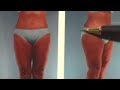 Liposuction and Tummy Tucks Liposuction and Tummy Tucks