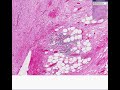 Histopathology Pancreas -- Adenocarcinoma