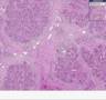 Histopathology Pancreas -- Adenocarcinoma