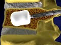 Kyphoplasty
