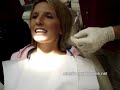 How To Adjust A Labial Bow How To Adjust A Labial Bow