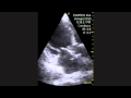 Aortic Endocarditis Aortic Endocarditis
