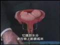 堕胎教育视频