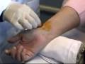 Arterial Blood Gas Sampling