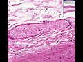 Histopathology Aorta--Atherosclerosis with fatty streak Histopathology Aorta--Atherosclerosis with fatty streak