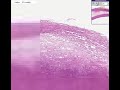 Histopathology Aorta--Atherosclerosis with fatty streak