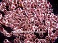 Rouleaux in Dark Field Live Blood Analysis