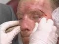 Micky Ward's boxing recovery. Micky Ward vs Arturo Gatti
