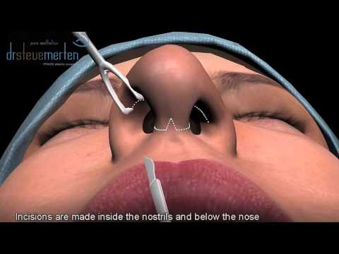 how to properly massage nose after rhinoplasty