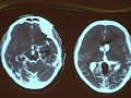 Subarachnoid hemorrhage