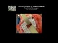 Brain Metastasis.wmv