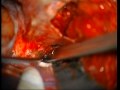 My Brain Surgery - Part 05 of 14