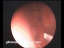Submucosal resection of septum.avi Submucosal resection of septum.avi