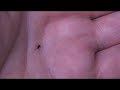 Big Hungry Tick 1 Big Hungry Tick 1