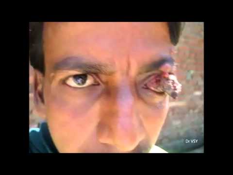 eyeball - Here you can see a worst case of eyeball growth, condition is quite painful present for last 5-6 years. Movements of eyeball are present. Along with this som...