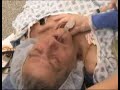 orotracheal intibutation 2
