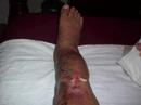 my leg