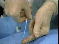 Pulmonary Artery Catheterization