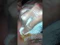 Giant Pimple Pop (0:45 - 2:00 = the best action)