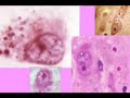Alzheimer's Disease Caused by Infection