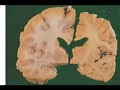Alzheimer's Disease Caused by Infection