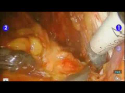 nodes - robotic assisted radical prostatectomy with lymph node dissection. Learn more at www.texasroboticsurgery.com.