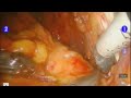 robotic assisted radical prostatectomy with lymph node dissection. Learn more at www.texasroboticsurgery.com
