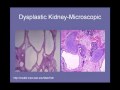 Cystic Kidney Disease -- other than ADPKD - YouTube