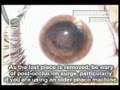 Posterior Subcapsular Cataract (PSC) Surgery - Phaco Soft Technique Posterior Subcapsular Cataract (PSC) Surgery - Phaco Soft Technique