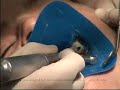 Media Root Canal Demonstration