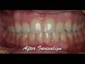 Invisalign Express with Whitening--Before & After-Mick Famil